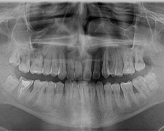 radiografie dentara & pierdere de os