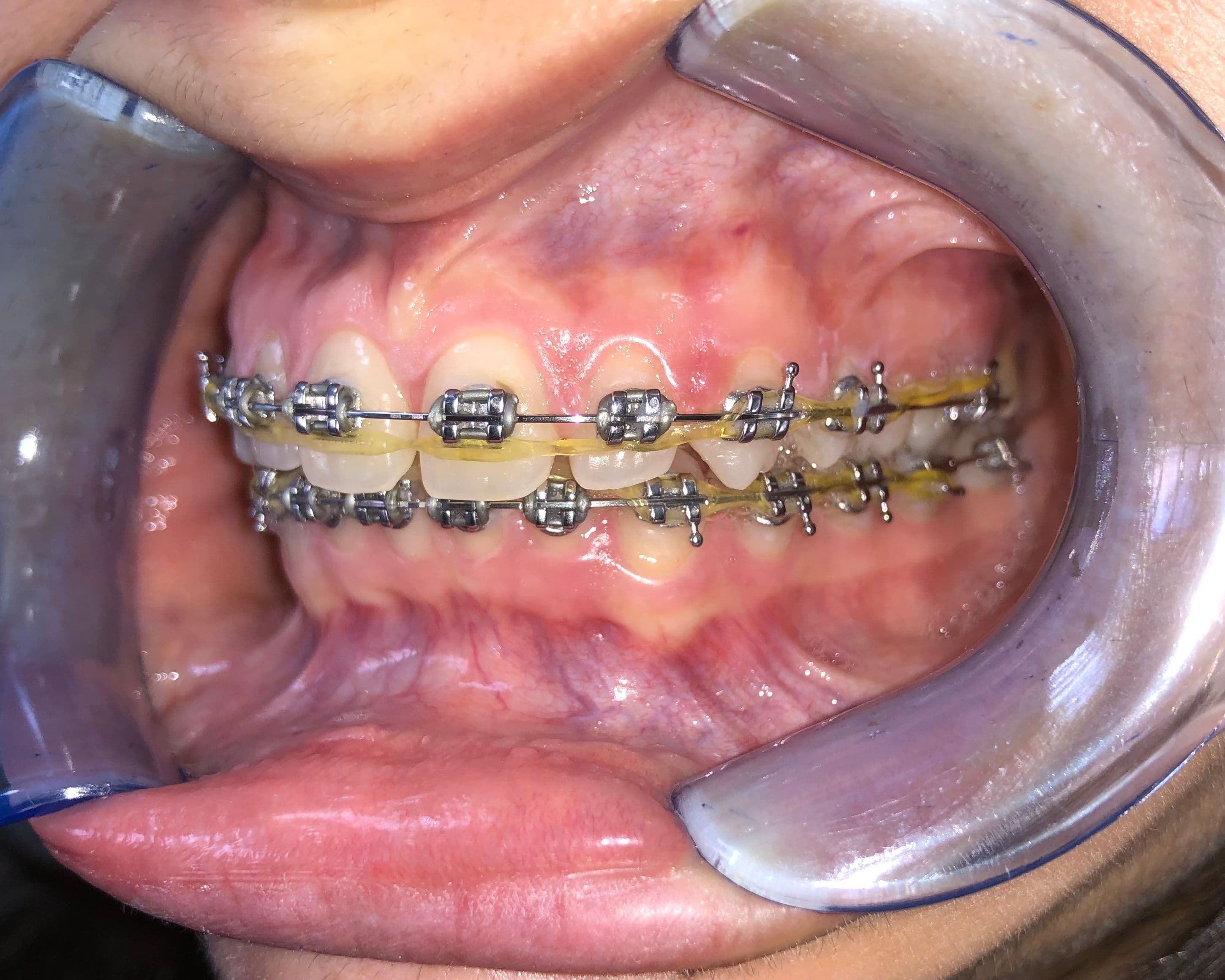 Protruzie superioara si inferioara corectata 